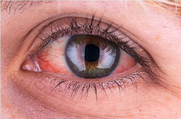 Red eye (medicine) - Wikipedia